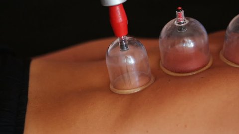 Traditional Chinese Medicine – Cupping process. Hijamah Cups on back of female patient in Acupuncture therapy. Chinese Traditional  treatment. Medical cupping therapy equipment.