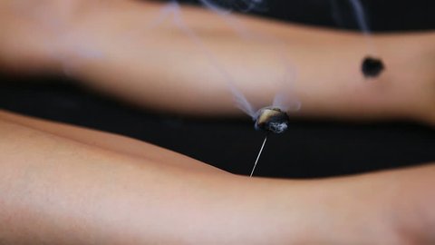 Traditional Chinese Medicine – Acupuncture process. Acupuncture needles on the female body in Acupuncture therapy. Chinese Traditional  treatment. Medical Acupuncture therapy equipment.