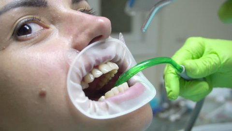 Young woman with an expander in mouth at the dental clinic. Cleaning teeth with water. Modern dental office. Dentist using saliva ejector or dental pump to evacuate saliva. Shot in 4k