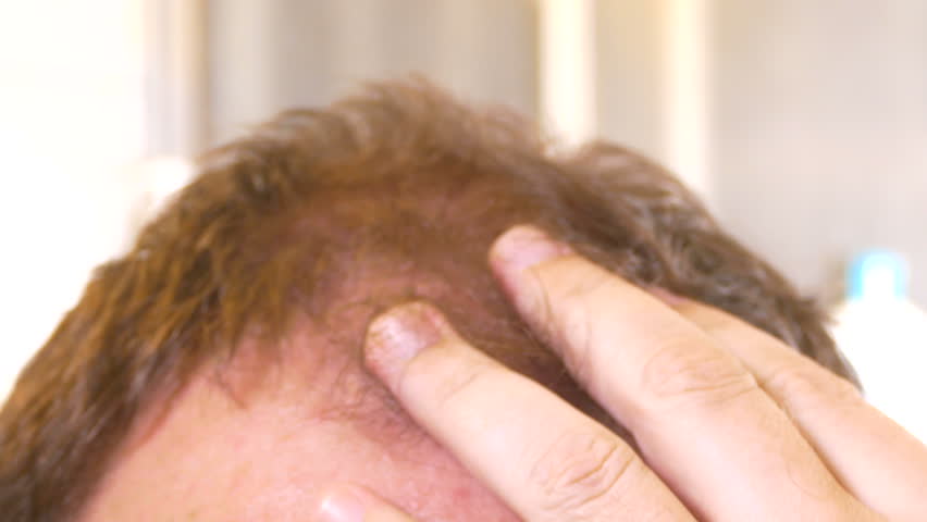 Man strokes receding hairline, closeup Shutterstock HD Video #26407559.