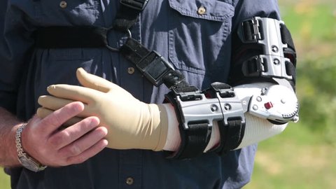 Man in adjustable prosthetic arm brace rubs arm in pain