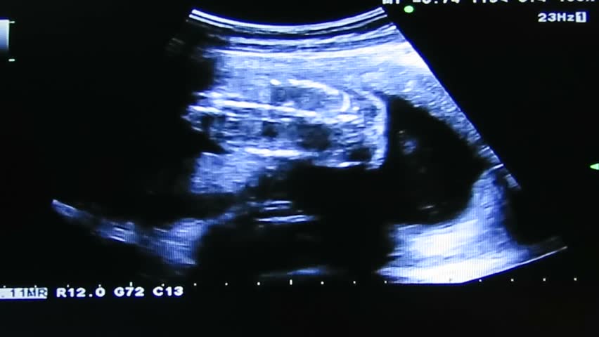 Baby ultrasound of 20st weeks with the Spine, Bladder and baby is male. Royalty-Free Stock Footage #26481866