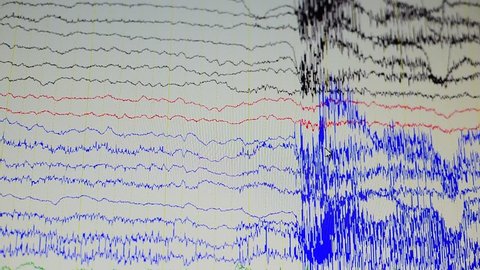 EEG wave in human brain,Abnormal EEG,Brain wave on electroencephalogram ,EEG wave during EEG record.