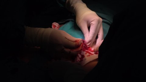 doctor pucture femoral artery to insert IABP catheter before open heart surgery