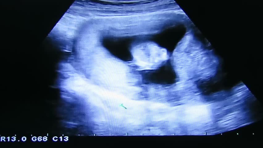 13 ultrasound weeks at 