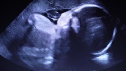 Footage Ultrasonography of third trimester pregnancy.