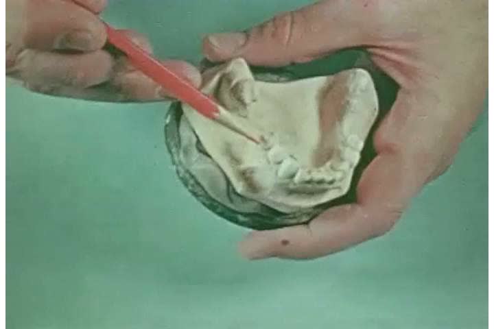 1940s: A dentist points to contours in upper and lower dentures, in 1944.