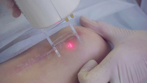 Woman getting a laser skin treatment or Laser resurfacing of scars in a skincare cosmetology clinic. Resurfacing technique for wrinkles, scars and solar damage to the skin