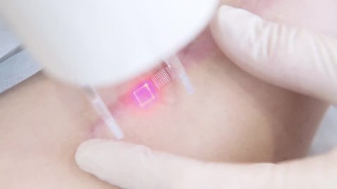 Woman getting a laser skin treatment or Laser resurfacing of scars in a skincare cosmetology clinic. Resurfacing technique for wrinkles, scars and solar damage to the skin