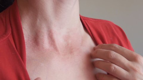 Woman scratch the itch with hand, Neck. Red spots on the neck, allergies, psoriasis, insect bite. Malaria. Sunburn. Sun burn