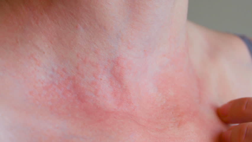 Woman scratch the itch with hand, Neck. Red spots on the neck, allergies, psoriasis, insect bite. Malaria. Sunburn. Sun burn Royalty-Free Stock Footage #27082921
