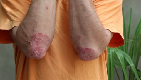 Psoriasis on the elbows. Psoriasis is a noncontagious, chronic skin condition that produces plaques of thickened, scaling skin