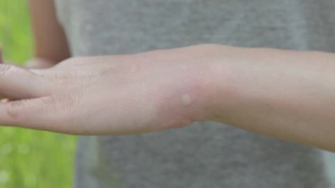 Insect bite, mosquito, tick. Irritation. The girl scratches her arm.
