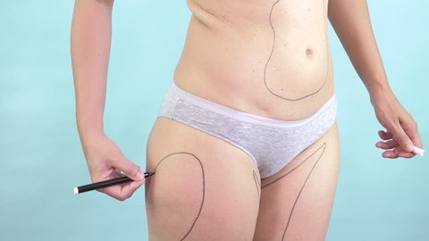Woman drawing body plastic surgery lines to slim and reduce fat. Caucasian female torso with correction mark for cosmetic liposuction of hips and thighs. Body control, weight loss, cellulite removal