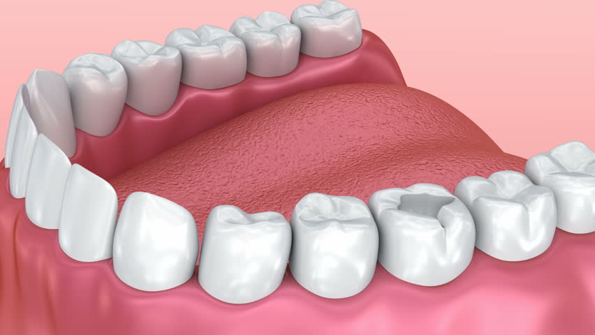 Ceramic dental fillings, Medically accurate 3d animation | Shutterstock HD Video #27931441