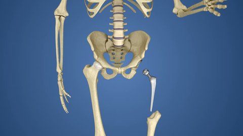 Hip replacement implant installed in the pelvis bone. Medically accurate  3D animation