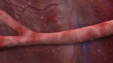 3D footage of the effect of thrombosis (clot formation) within a capillary supplying blood to the brain causing an accumulation of erythrocytes and cerebral ischaemia 