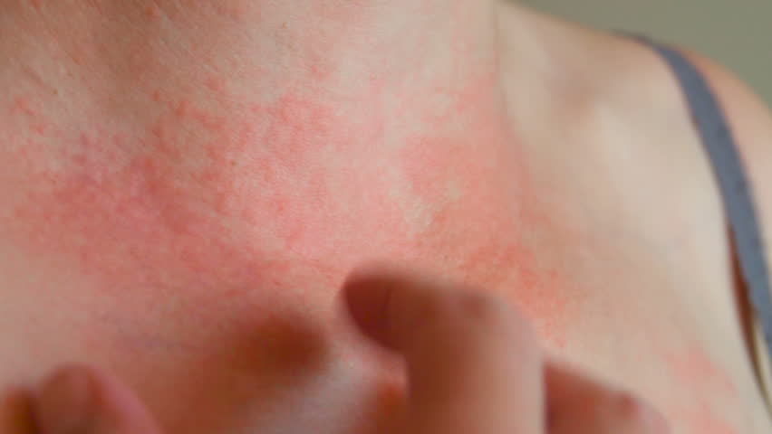Woman scratch the itch with hand, Neck. Red spots on the neck, allergies, psoriasis, insect bite. Malaria. Sunburn. Sun burn Royalty-Free Stock Footage #28306954
