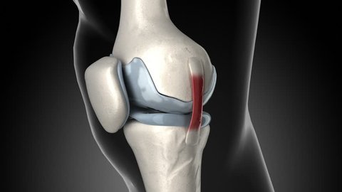 Painful knee arthritis animation