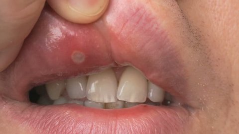 Stomatitis into mouth. Man bends his upper lip and shows sore spot of ulcer. Close-up