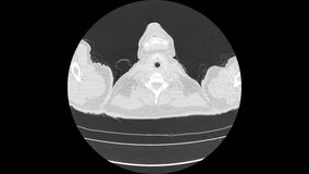 ct scan of upper abdomen top view smooth motion