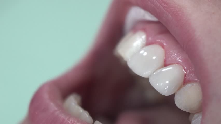 Dentist puts dental veneers patient Royalty-Free Stock Footage #29375653