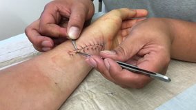pulling threads after an operation