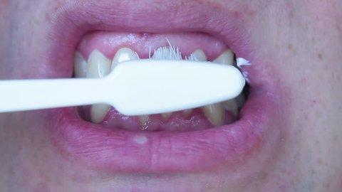 Bleeding gums when brushing teeth