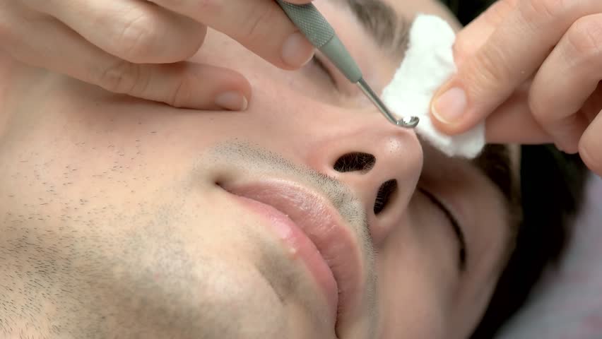 facial blackhead removal near me