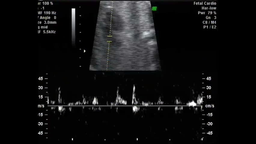 Ultrasound Screen of Human Fetus Stock 