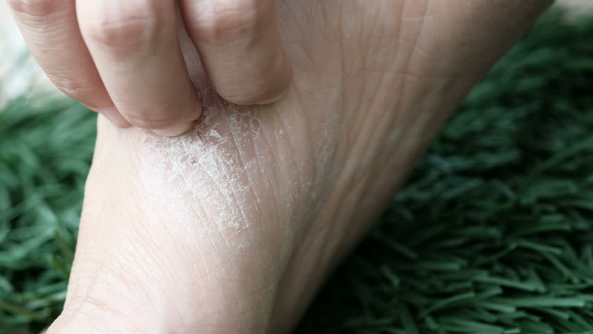 4K footage of Person scratching skin, Psoriasis on the foot shows redness and applying and dry flaky skin and other dry skin conditions. Royalty-Free Stock Footage #31170811