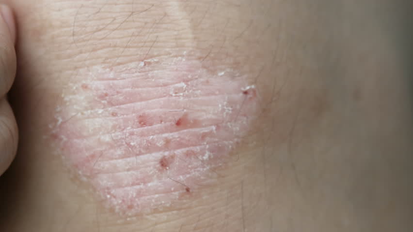 4K footage of Person scratching skin, Psoriasis on the knee shows redness and applying and dry flaky skin and other dry skin conditions. Royalty-Free Stock Footage #31170814