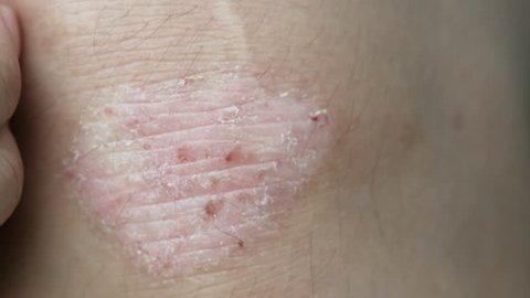 4K footage of Person scratching skin, Psoriasis on the knee shows redness and applying and dry flaky skin and other dry skin conditions.