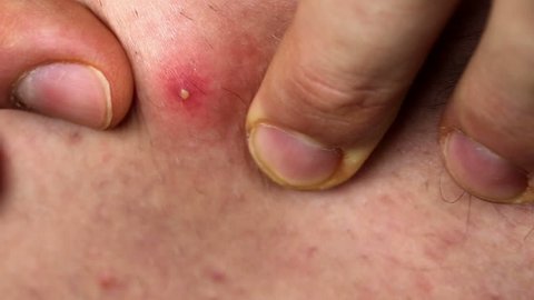 pimple popping gif