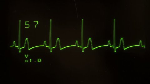 EKG defibrillator screen heart flatlines - with sound, HD 1080