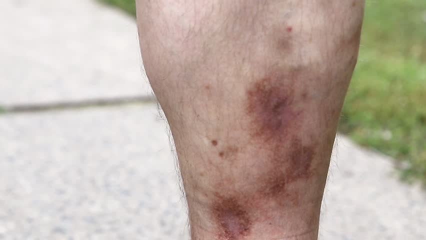 Psoriazis varicos, Psoriazis varicoz