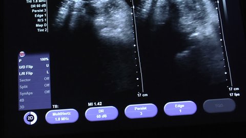 A 4d Ultrasound Of A Stock Footage Video 100 Royalty Free Shutterstock