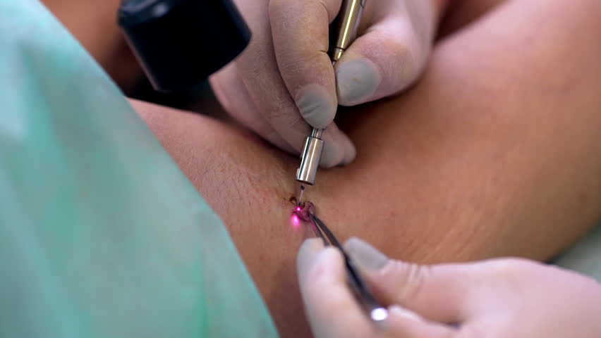 Cosmetician cauterizing removing big mole from woman's armpit