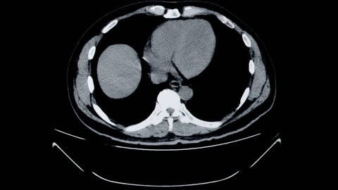 Computed Tomography Abdomen (CT SCAN)
