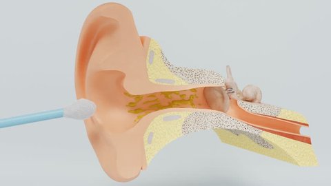 Right way of using cotton swab. Ear wax cleaning. Model of the inner ear.