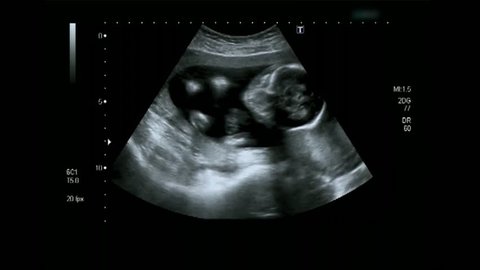 Ultrasonography of pregnant woman