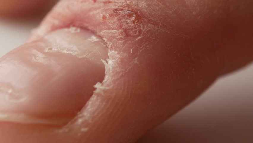 Fingers and nails of a patient with psoriasis. The man nervously knocks the tip of his finger on the table. | Shutterstock HD Video #32363584