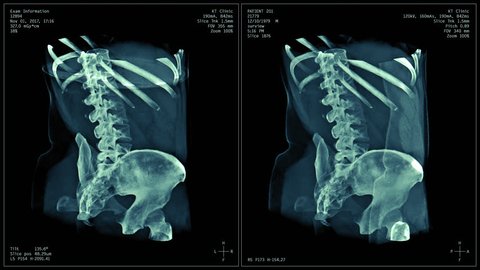 Body CT scan image, radiography x-ray examination, MRI tomography seamlessly looped animation, 3d visualization of real body computed tomography scanning with info-graphics. 스톡 비디오