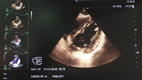 A monitor of the ultrasound machine, which shows the work and beating of the heart and its valve in real time.