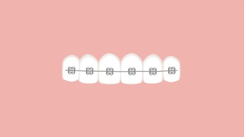 Video animation of braces straightening teeth