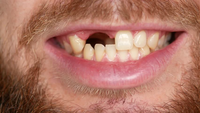 Close-up of the mouth. A man shows his denture | Shutterstock HD Video #33043711