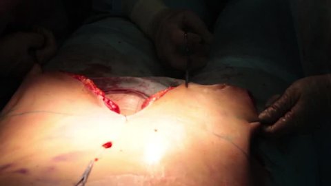 Doctor Marker cutting line during a tummy tuck