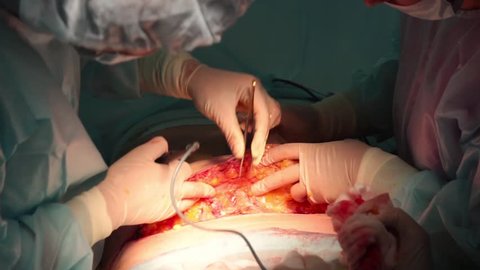 The surgeon separates the fatty tissues on the abdomen of the patient with an electric scalpel during plastic surgery