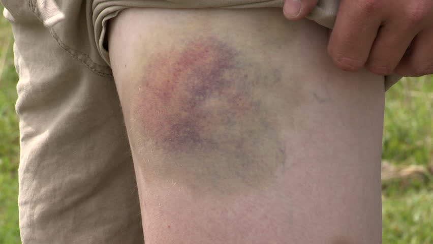 Large bruise on woman's leg.