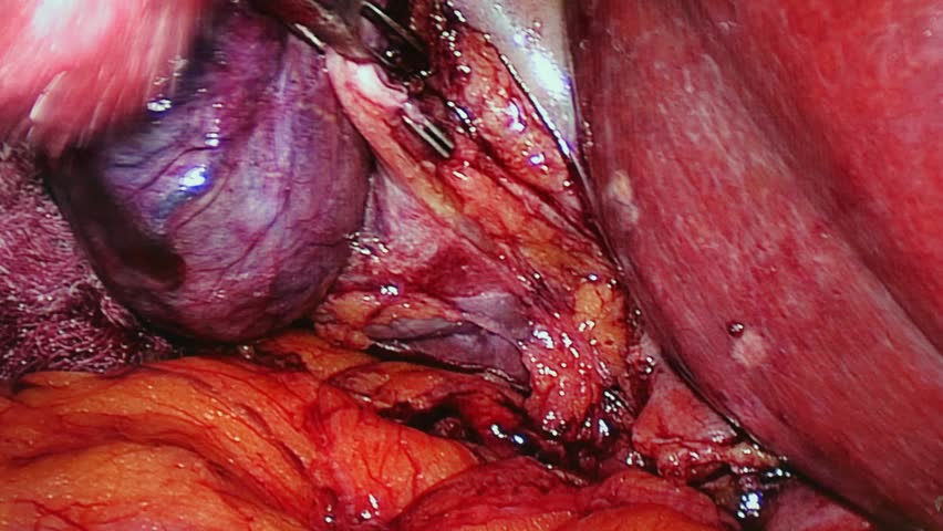 Abdominal Cavity Inside During Operation Stock Footage Video (100%